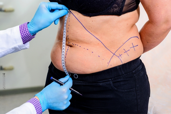 How Tummy Tuck Surgery Can Improve Your Quality of Life | dubai