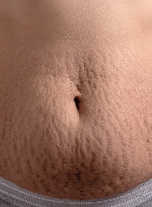 Stretch Marks