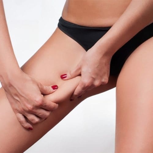 Thigh Lift After Weight Loss in Dubai