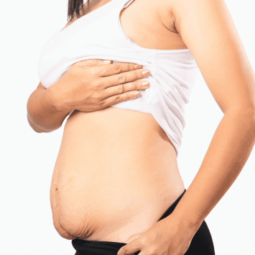 tummy tuck after pregnancy