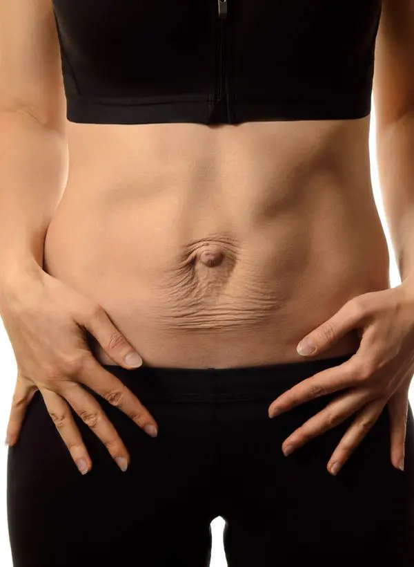 Streth marks on tummy tuck