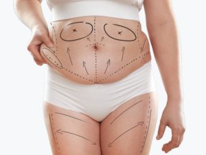 Abdominoplasty vs Tummy Tuck