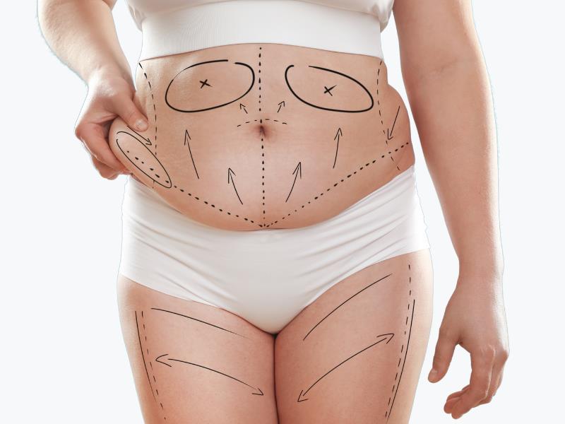 Abdominoplasty vs Tummy Tuck: Is There Any Difference? 1 Abdominoplasty vs Tummy Tuck