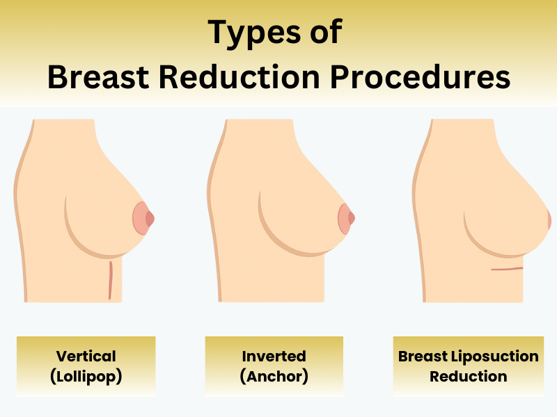 Breast Reduction Procedures