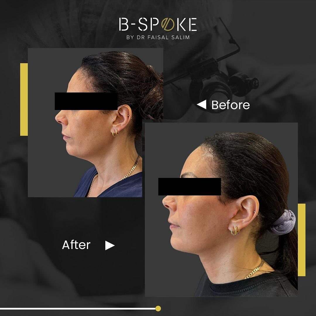 Deep plane facelift  27 Deep Plane Facelift Before after Image-3