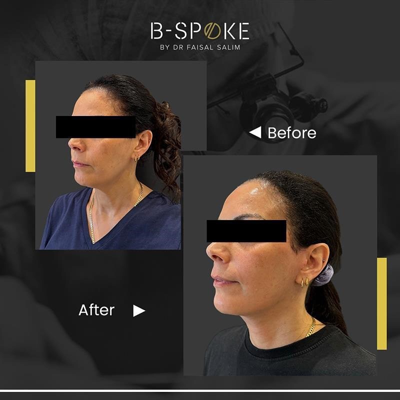 Deep plane facelift  28 Deep Plane Facelift Before after Image-2