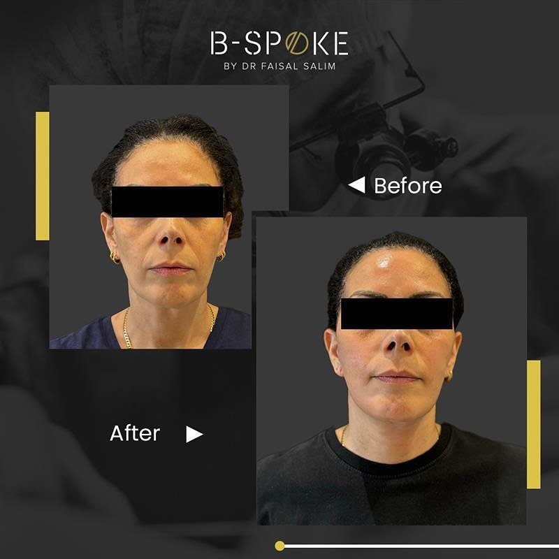 Deep plane facelift  29 Deep Plane Facelift Before after Image-1