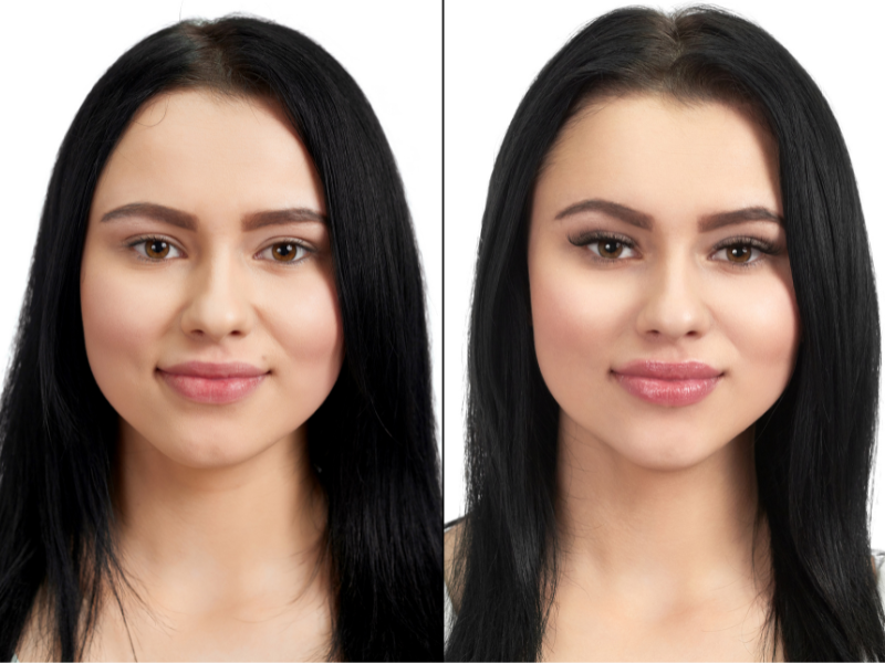 Eyelid surgery in Dubai 9 Blepharoplasty Before and After Results