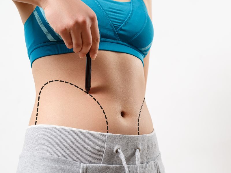 what is lipo abdominoplasty