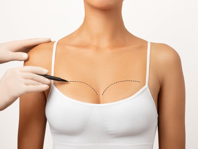 What Is Dual Plane Breast Augmentation