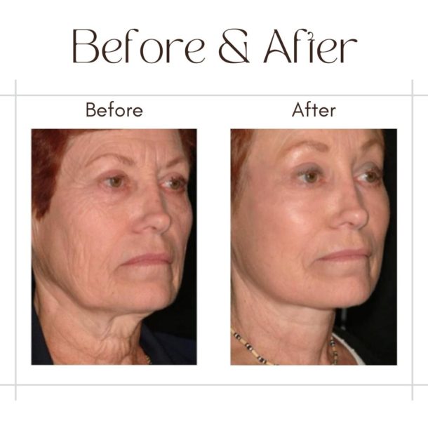 Facelift in Dubai By Dr Faisal before and after images