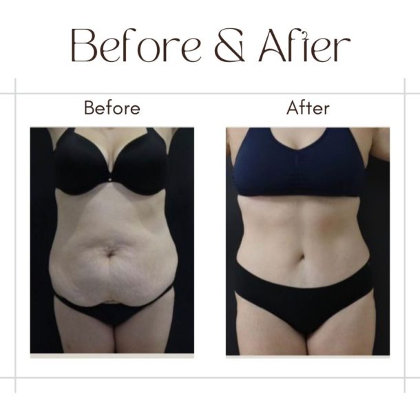 Abdominoplasty in dubai by Dr Faisal before and after images