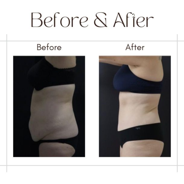 Tummy Tuck in dubai by Dr Faisal before and after images