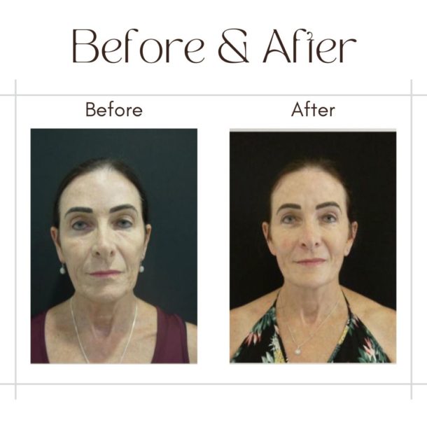 Facelift Surgery in Dubai By Dr Faisal before and after images
