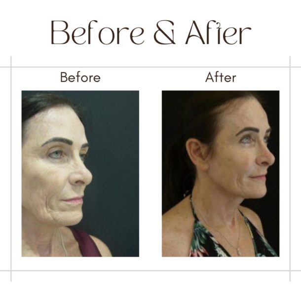 Facelift in Dubai Before and After images