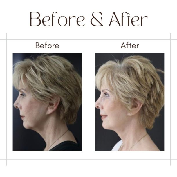 Face lift in Dubai Before and After images